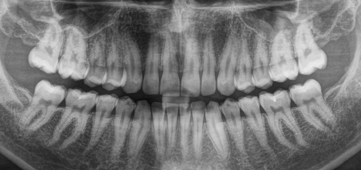 exposure to x ray