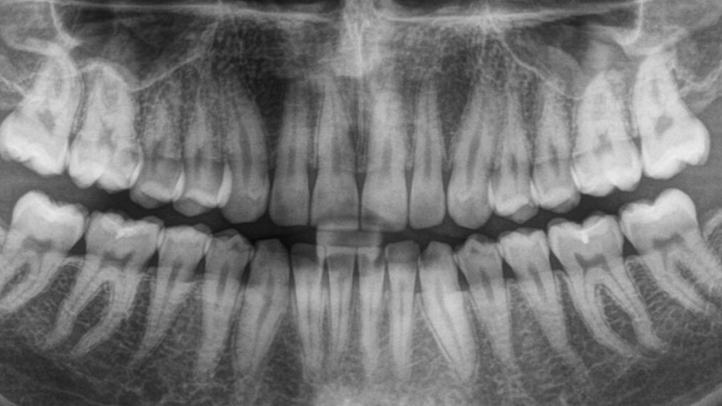 How Safe Are Digital Dental X-Rays?