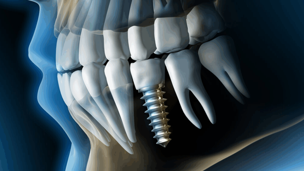 Are Dental Implants Right for Me?